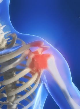 Schulterarthrose - Die Abnützung der Schulter